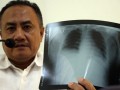 Suspect Mers Kediri Bertambah 