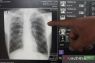 Menkes: Banyak pasien gagal sembuh TBC