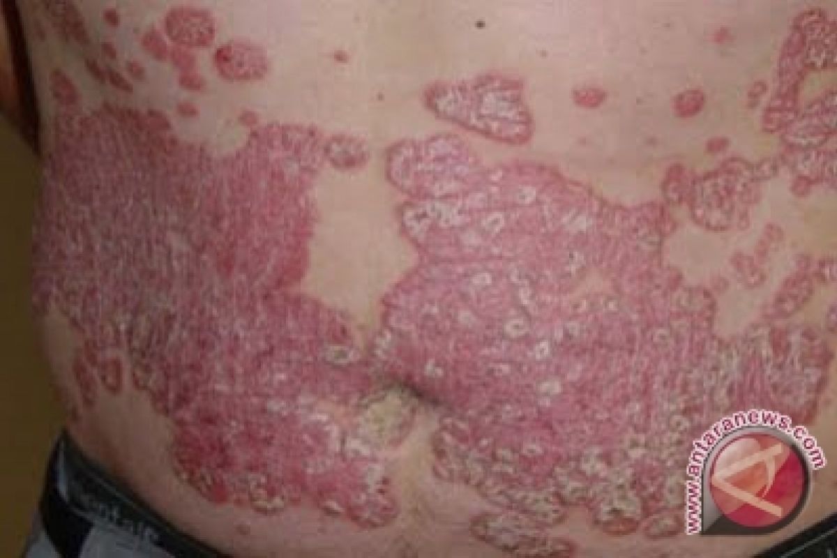 Ultraviolet sinar matahari hambat psoriasis