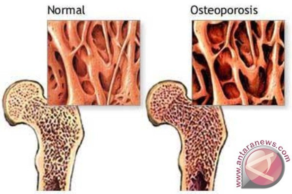 Peneliti Temukan Metode Baru Tingkatkan 30 Persen Volume tulang