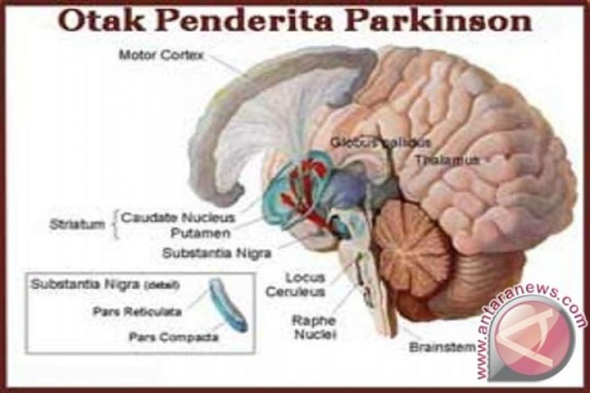 Peneliti Israel temukan penyebab Parkinson