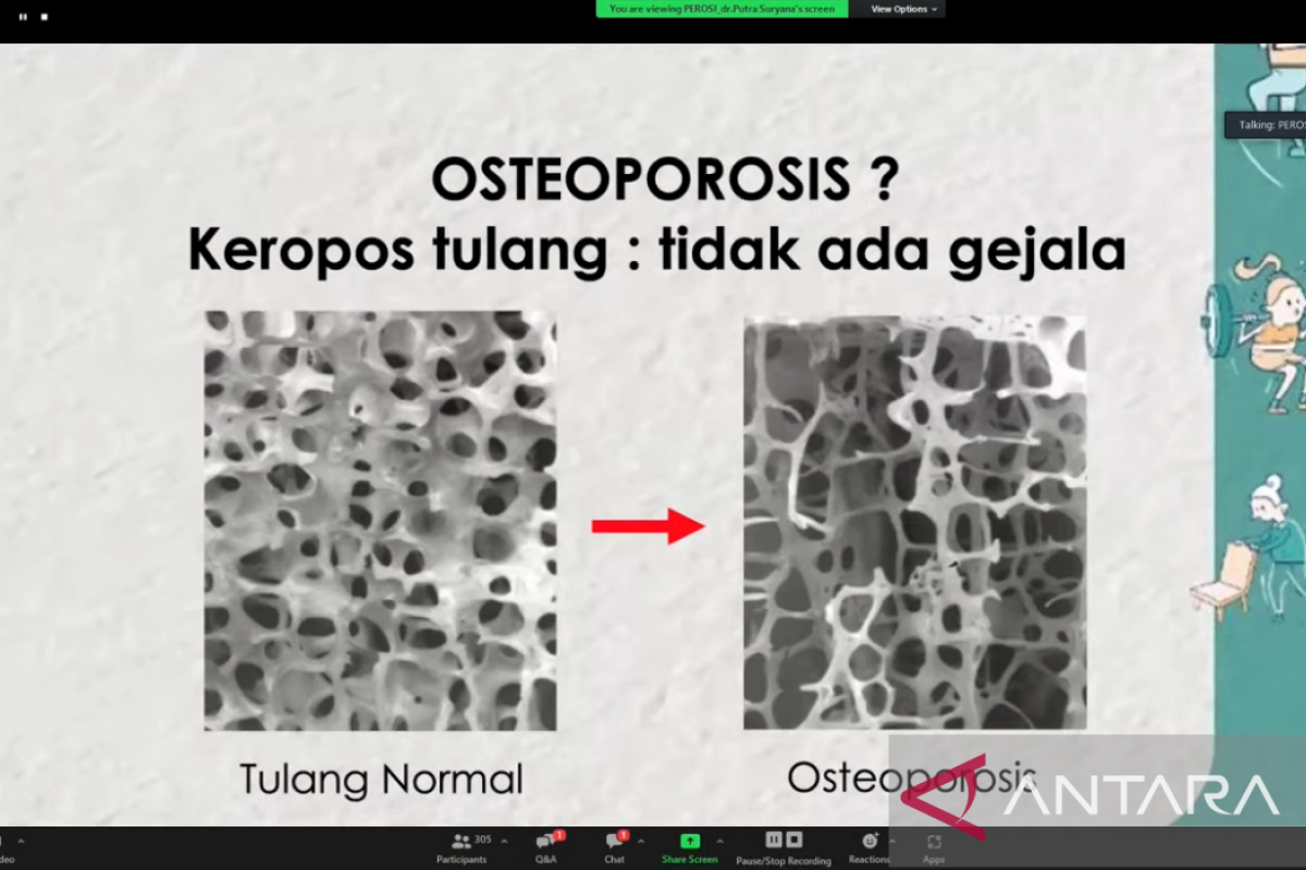 Pakar: Osteoporosis bisa  dicegah sejak anak-anak