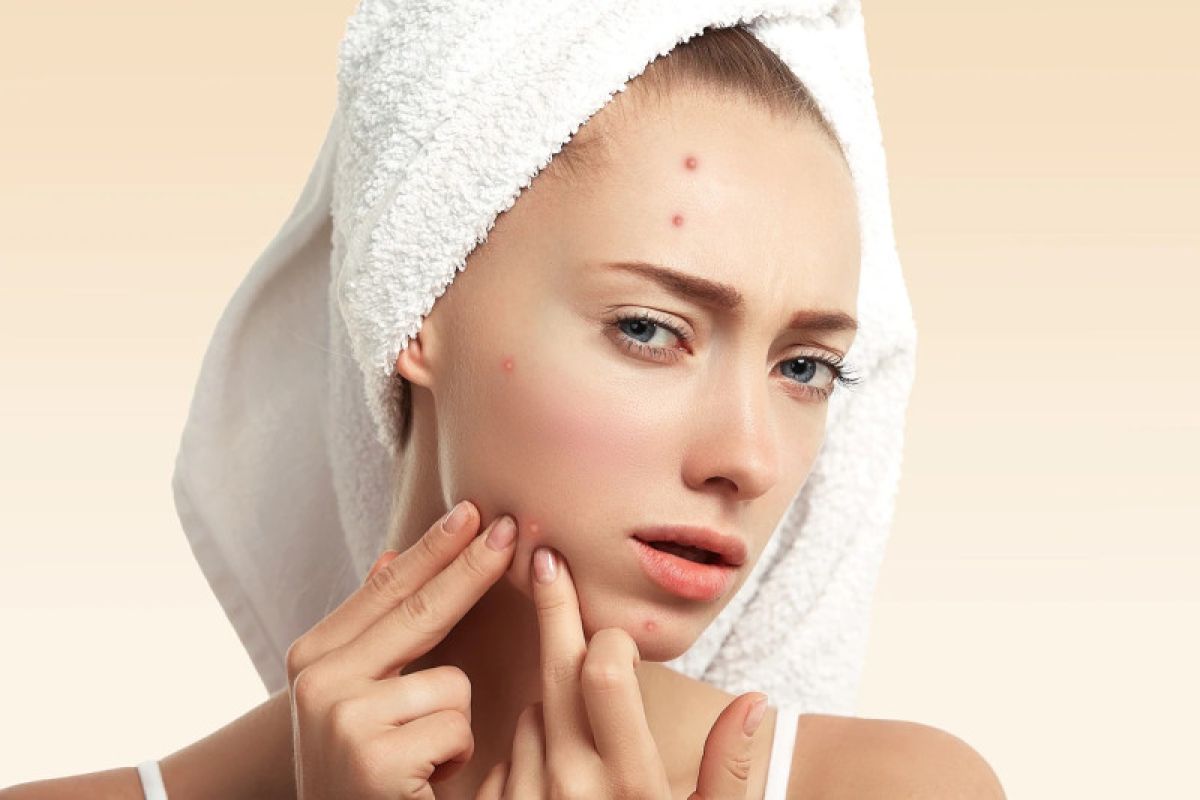 Kenali tanda 'fungal acne' yang berbeda dari jerawat biasa