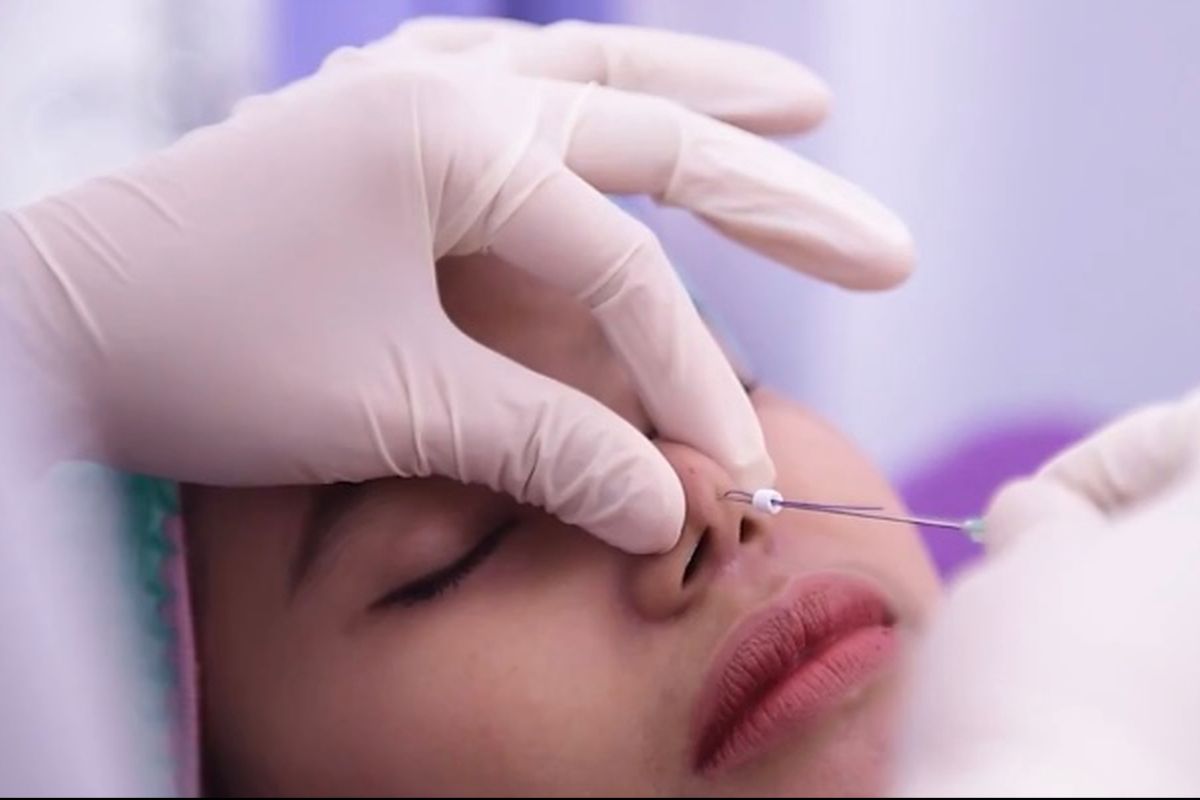 Filler dan Botox jadi tren perawatan kecantikan tahun ini