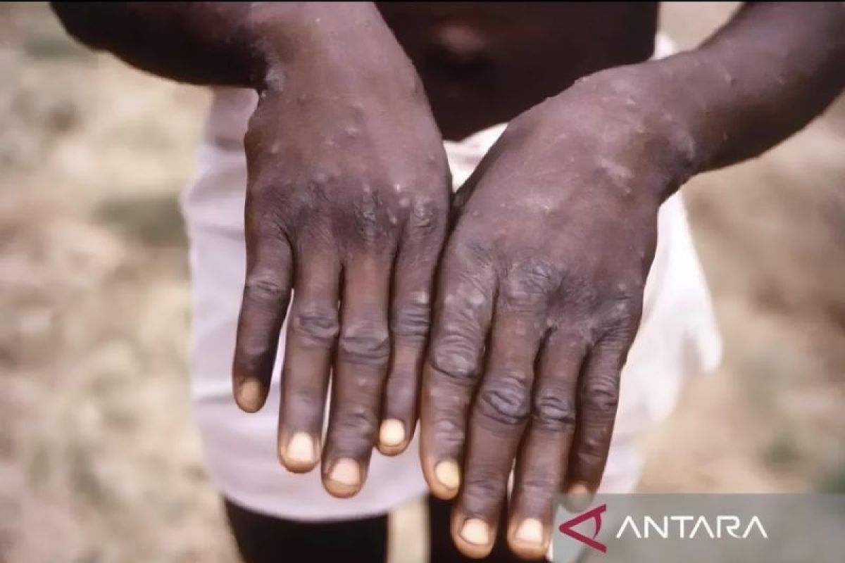 Indonesia expands monkeypox testing capacity