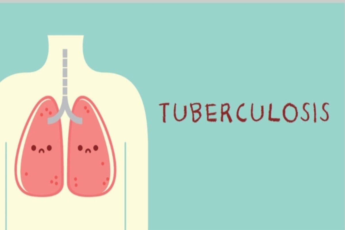 Prioritas Kesehatan Publik: Strategi Penanganan Tuberkulosis di Indonesia Terus Ditingkatkan