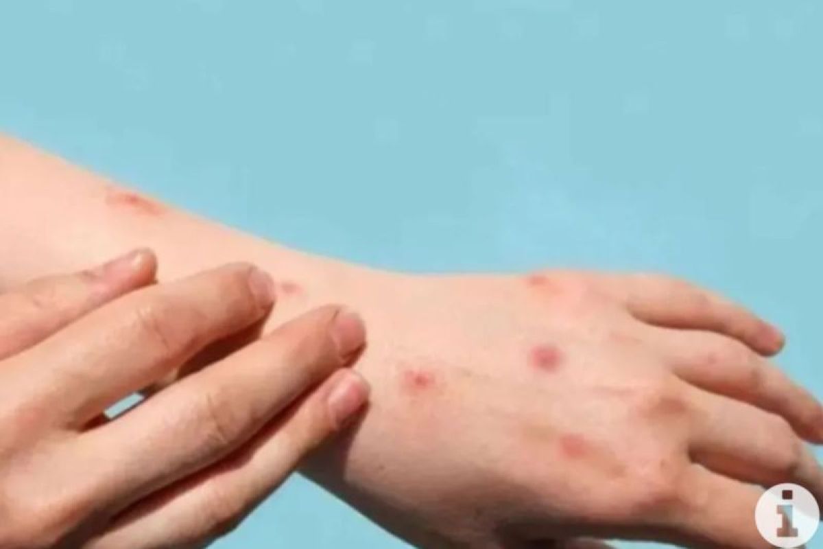 Karakteristik ruam klinis yang sering dijumpai penderita Mpox