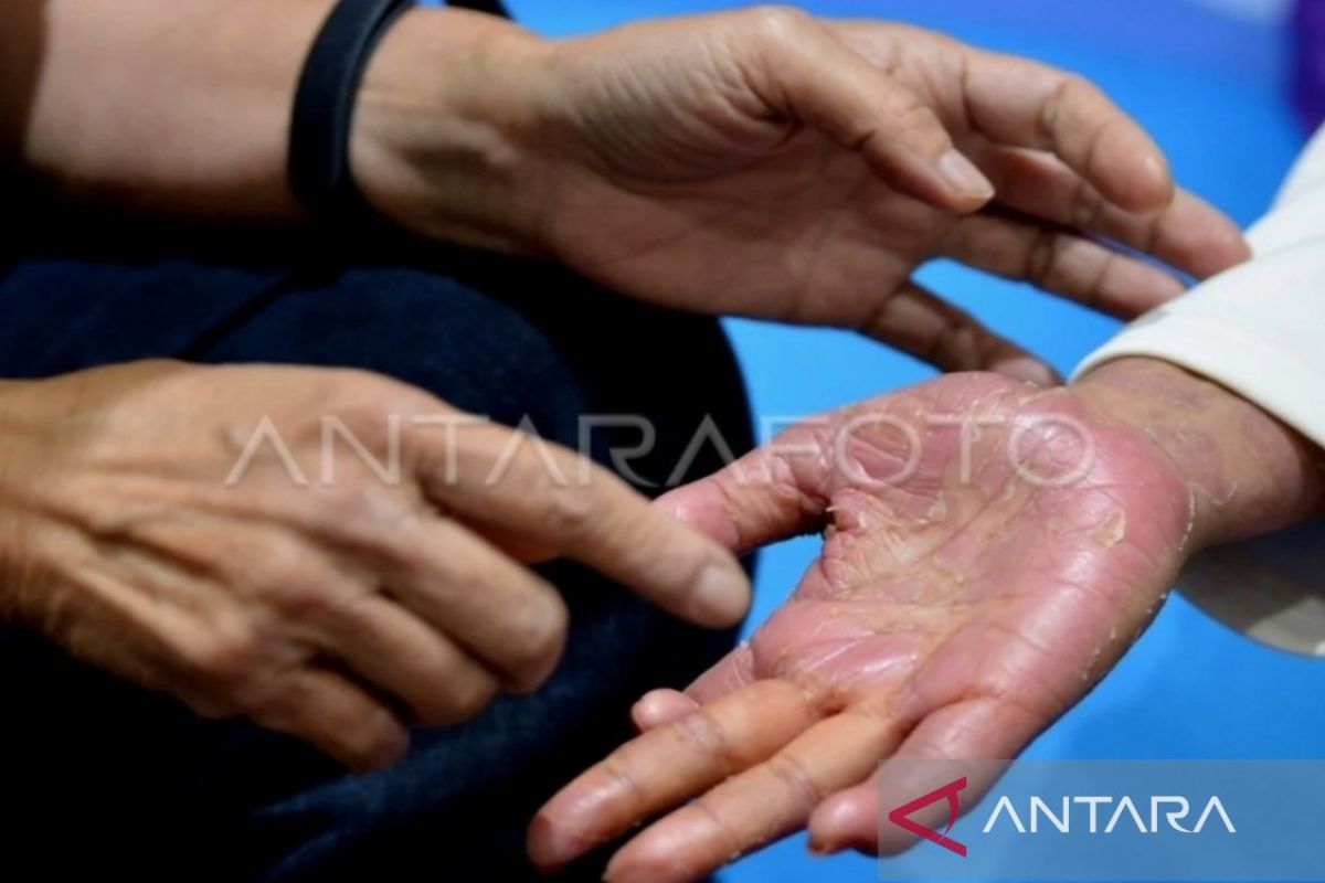 Mengenal psoriasis dan menangani dampak psikologis