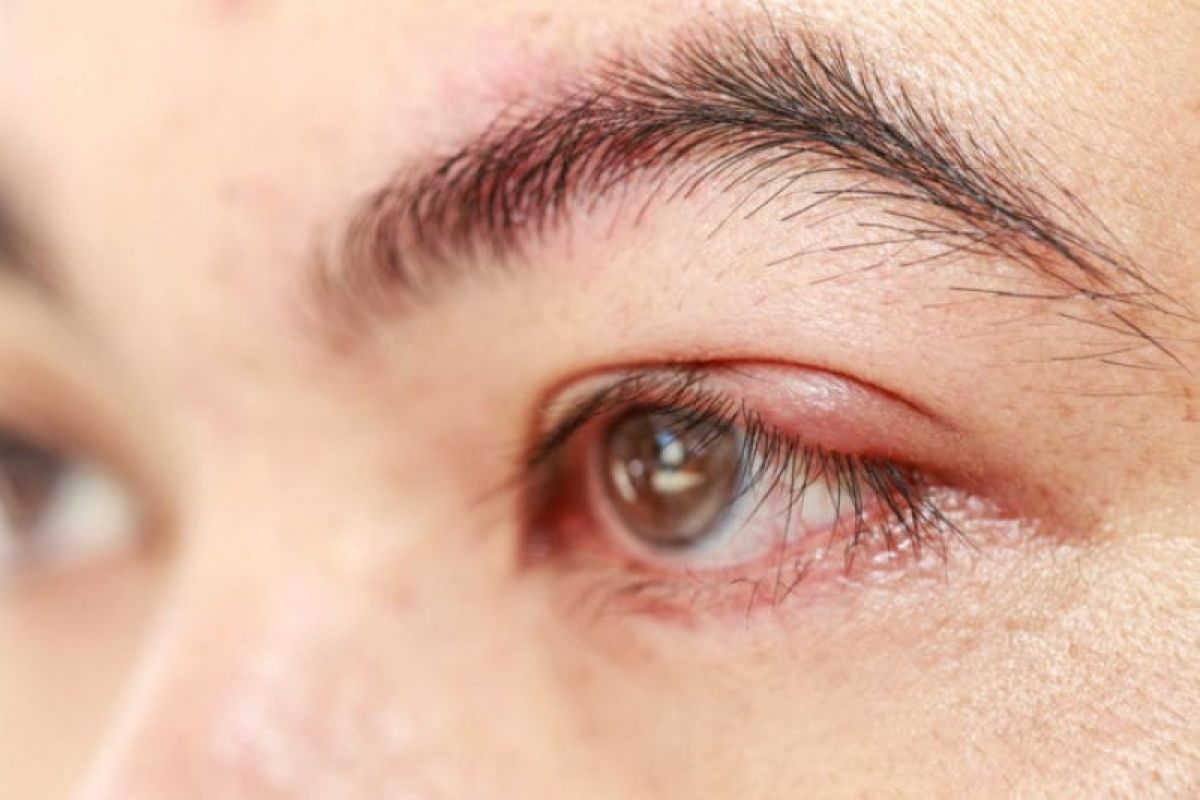 Kurang bersih saat hapus riasan mata dapat sebabkan penyakit hordeolum atau bintitan