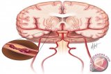 jawaban ahli: tusuk jari dengan jarum bisa tangani stroke?