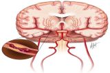 Kata Pakar Stroke Mulai Cenderung Dialami Orang Muda