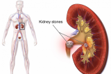 Mengenal apa itu batu ginjal dan cara pengobatannya