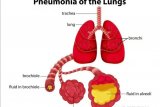 Gejala pneumonia sering dianggap sebatas pilek