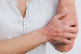 Stres dan cuaca bisa picu psoriasis