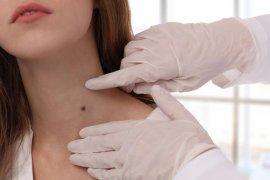 Dokter: Perhatikan bentuk tahi lalat untuk deteksi dini kanker kulit