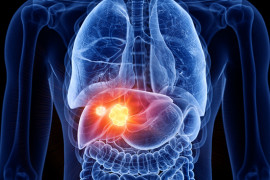 Ahli: Pemicu kanker hati karena obesitas dan diabetes