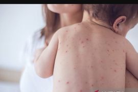 Vitamin A dosis tinggi penting cegah infeksi campak jadi lebih parah
