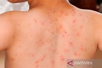 Kemenkes tanggapi perilaku influencer kena campak yang keluar rumah