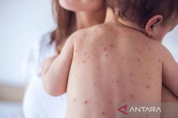 Kala campak mengintai balita