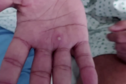 Epidemiolog minta pemerintah tingkatkan deteksi dini cacar monyet