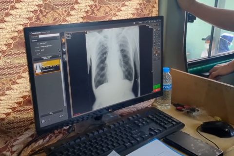 Menkes ungkap alasan Indonesia jadi lokasi uji vaksin Tuberkulosis