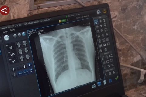 Kasus TBC di Sulsel sentuh angka 12 ribu, tertinggi ke 7 se-Indonesia