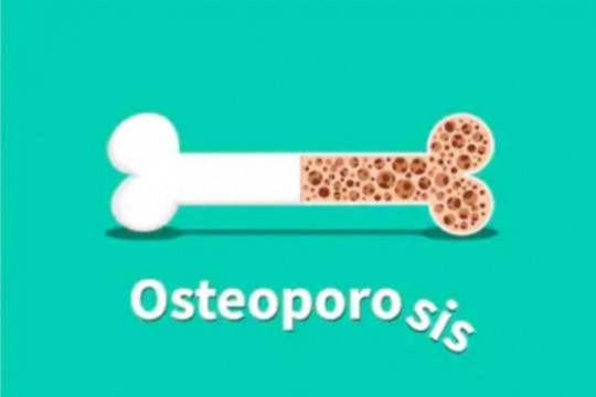 Dokter: Wanita lebih berisiko terkena osteoporosis