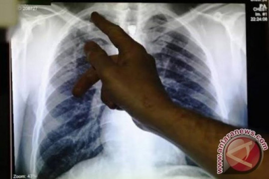 Pakar: Tuberkulosis di Indonesia harus ditangani bersama