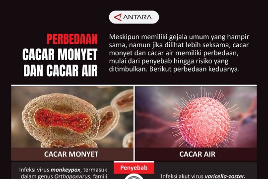 Perbedaan cacar monyet dan cacar air