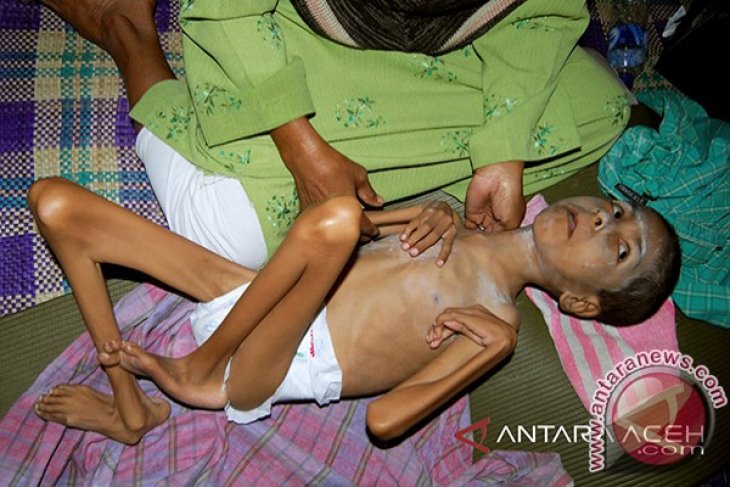 Penderita Gizi Buruk