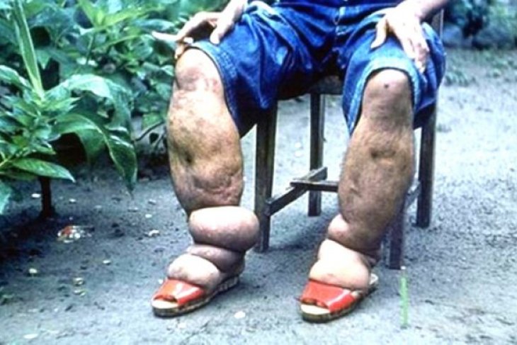 Unpatti - Dinkes Ambon penguatan menuju eliminasi filariasis pada 2020
