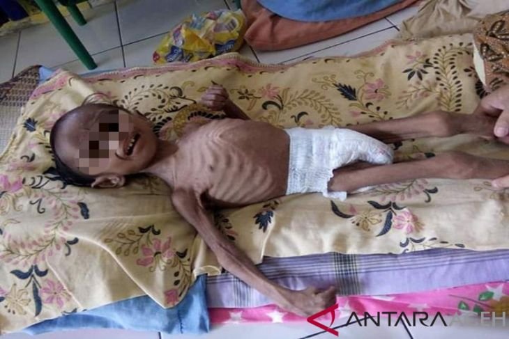 Seorang bocah di Aceh Utara derita gizi buruk