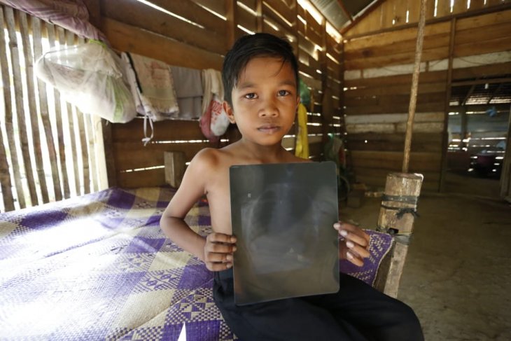 ACT galang donasi murid berprestasi alami penyakit jantung di Bireuen
