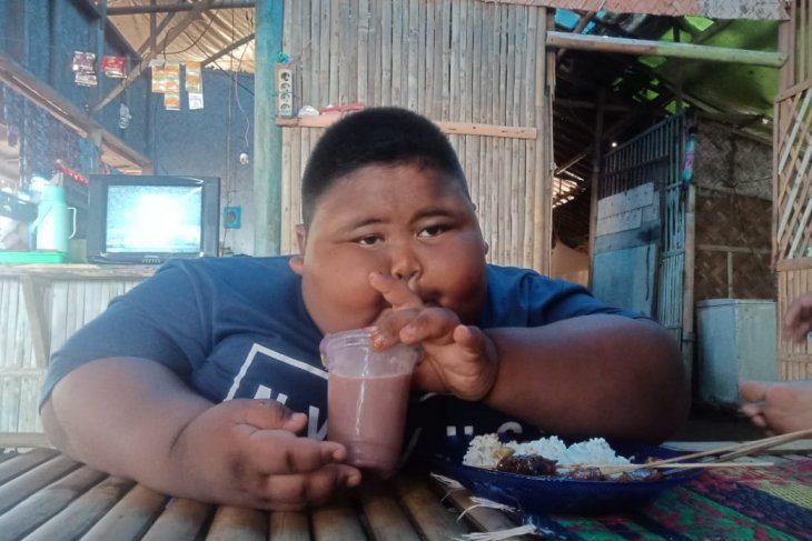 Bocah obesitas di Karawang, umur 7 tahun berat 97 kilogram