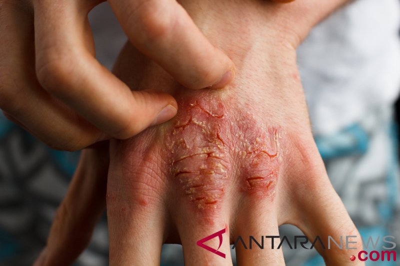 hogyan kell kezelni az izületi pikkelysömör bőrbetegségek vörös foltok a bőrbetegségen fotó
