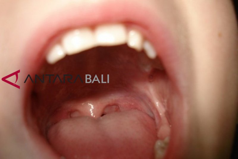 Waspada infeksi sekitar gigi tanda adanya kanker mulut
