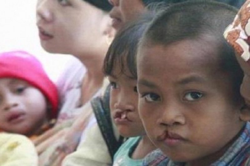 Bupati Ogan Komering Ulu bantu penderita bibir sumbing