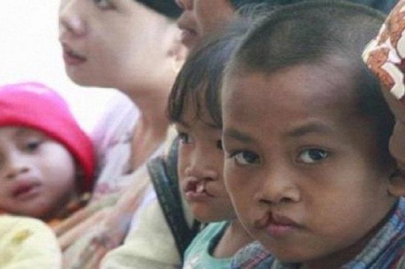 Puluhan warga bibir sumbing Ogan Komering Ulu dioperasi gratis