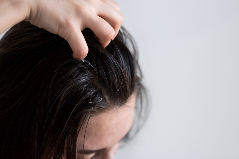 Fakta tentang scalp barrier dan cara menjaganya